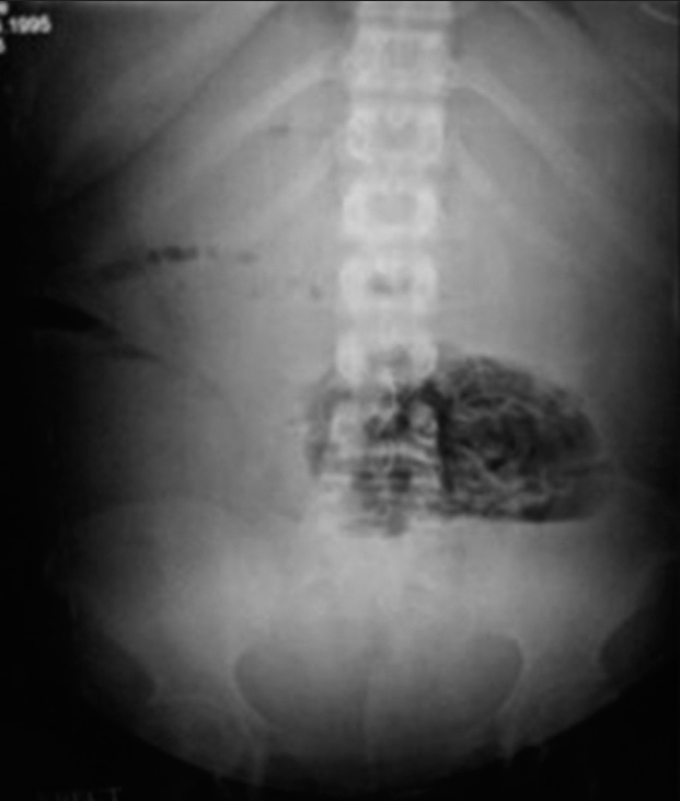 Erect view of plain abdominal radiograph.