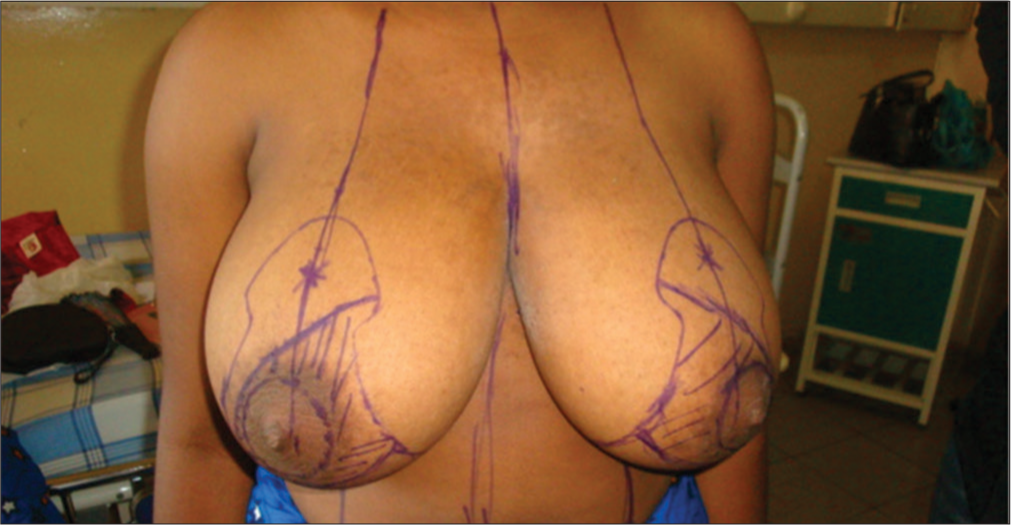 Pre-operative superior medial reduction mammaplasty skin marking.