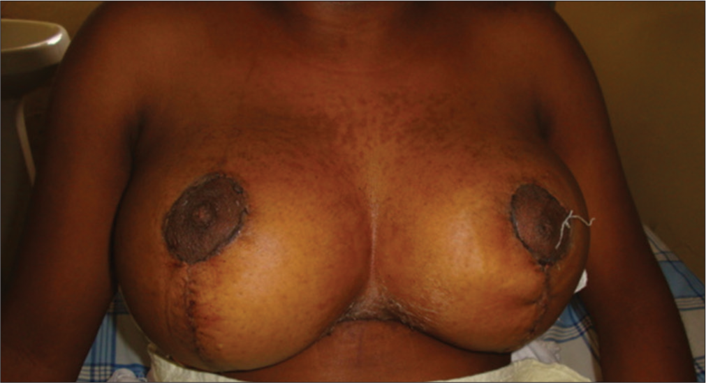 Post-operative images of vertical scar skin closure.